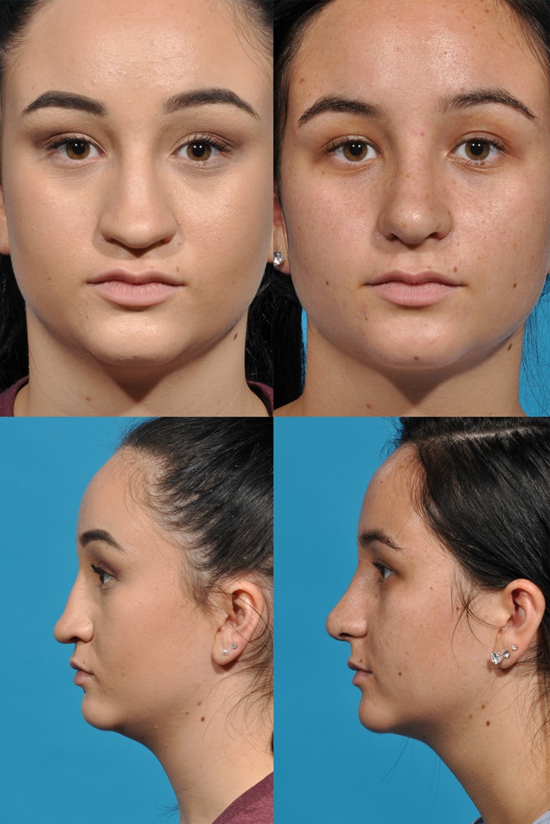 Aesthetic_Specialists_1-Rhinoplasty