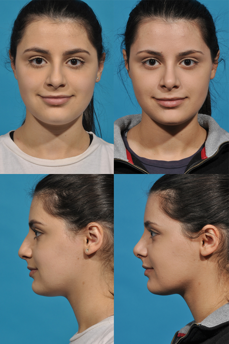 Aesthetic_Specialists_2-Rhinoplasty