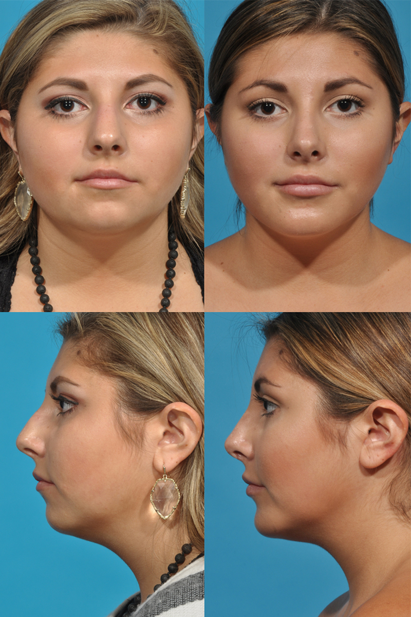 Aesthetic_Specialists_3-Rhinoplasty+Reconstructive-Surgery